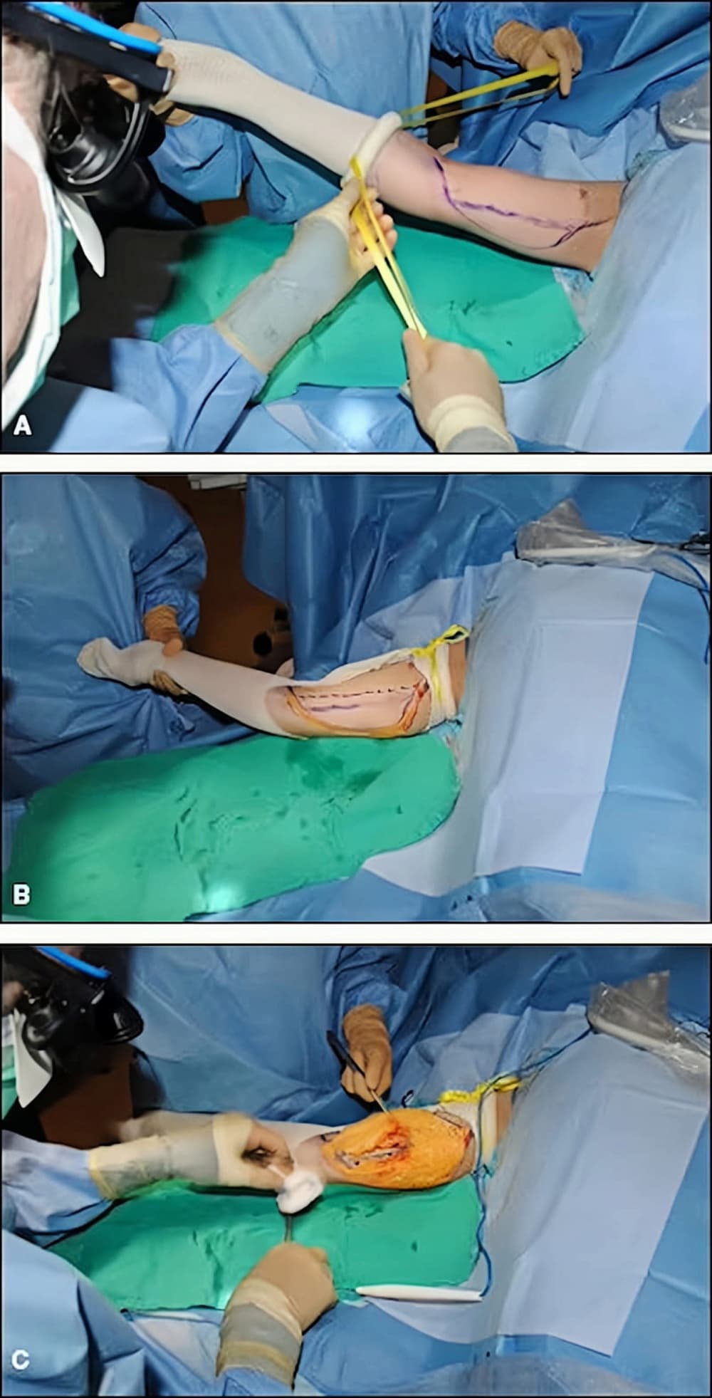 Tourniquet for Limb Surgery