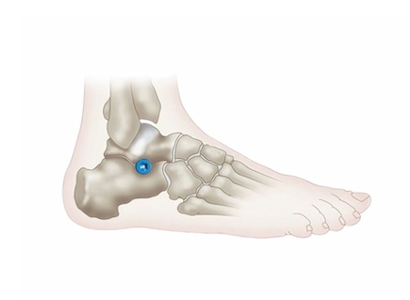 Surgical Procedure Of Subtalar Joint Stabilization Screw